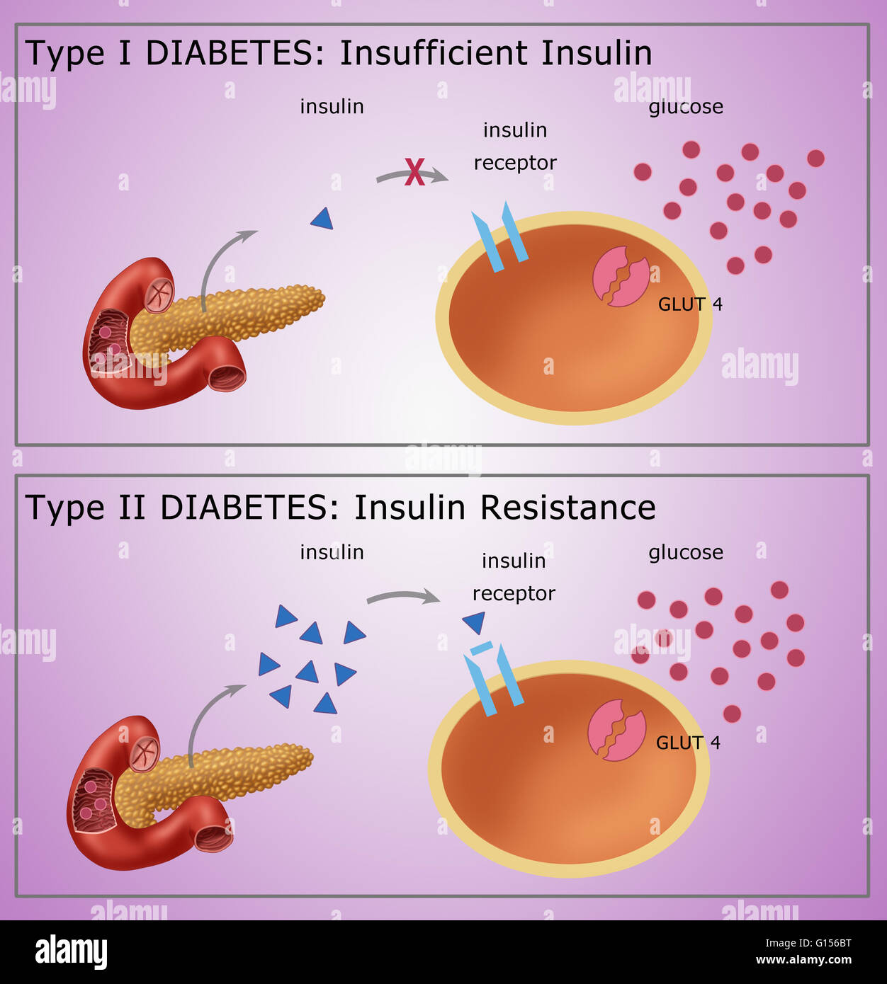 Illustration comparing Type I Diabetes (top) where the body fails to  produce sufficient insulin and Type II Diabetes (bottom) where the body  resists insulin. Depicted in the diagram are: Insulin (blue triangles),