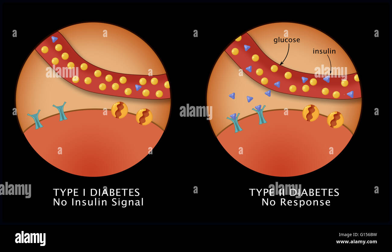 Illustration comparing Type I Diabetes (left) where the body fails to  produce sufficient insulin and Type II Diabetes (right) where the body  resists insulin. Depicted in the diagram are: Insulin (blue triangles),