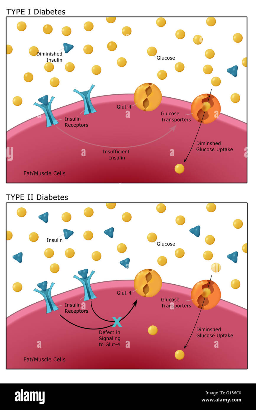 Illustration comparing Type I Diabetes (top) where the body fails to  produce sufficient insulin and Type II Diabetes (bottom) where the body  resists insulin. Depicted in the diagram are: Insulin (blue triangles),