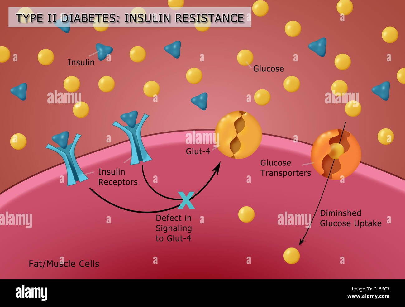 Illustration of insulin and glucose production in Type 2 diabetes