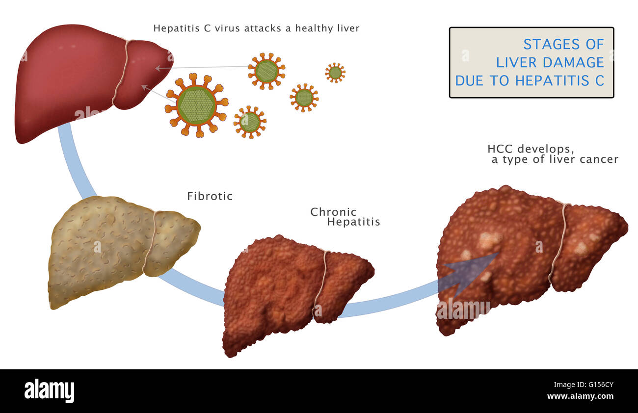 Liver Cirrhosis Final Stages