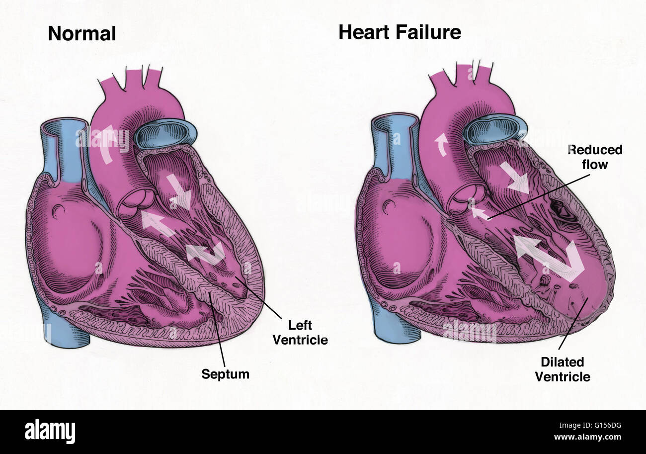 Illustration comparing the appearance and functioning of the heart of a