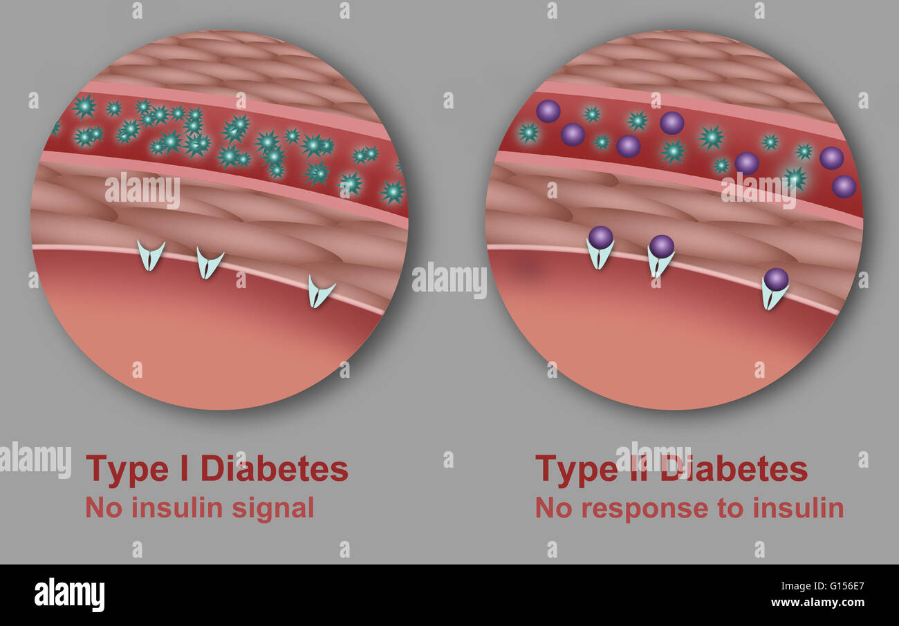 Illustration comparing Type I Diabetes (left) where the body fails to