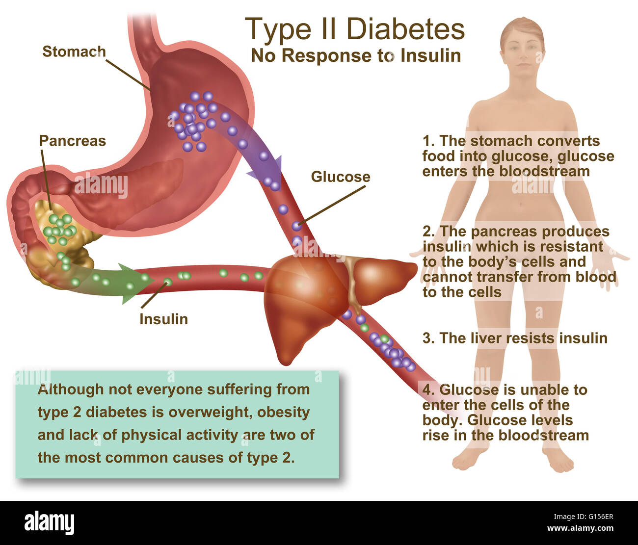 Llustration Of Insulin And Glucose Production In Type 2 Diabetes Insulin Is Produced By Islet 4756