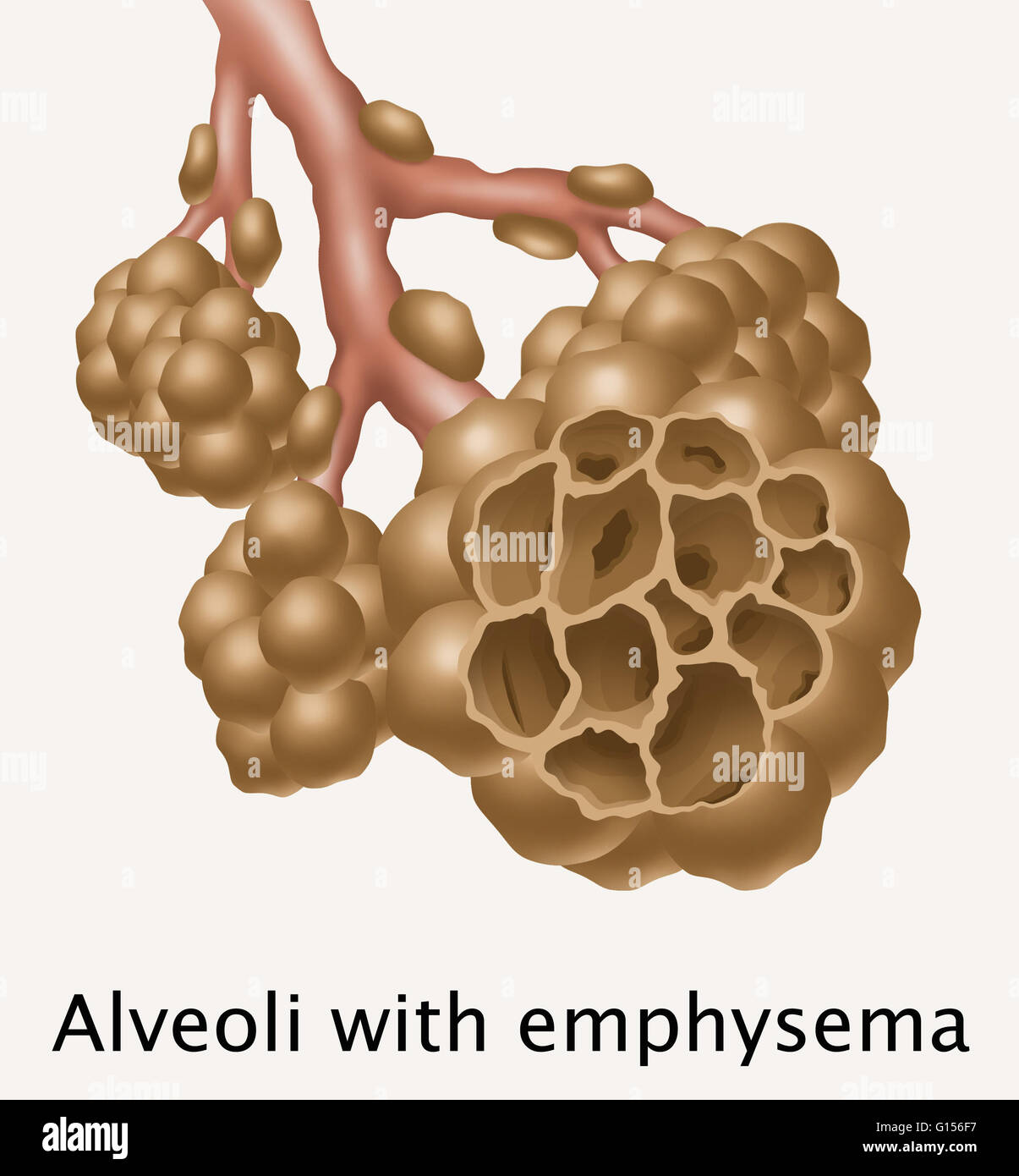 Illustration depicting alveoli affected by emphysema. The disease is