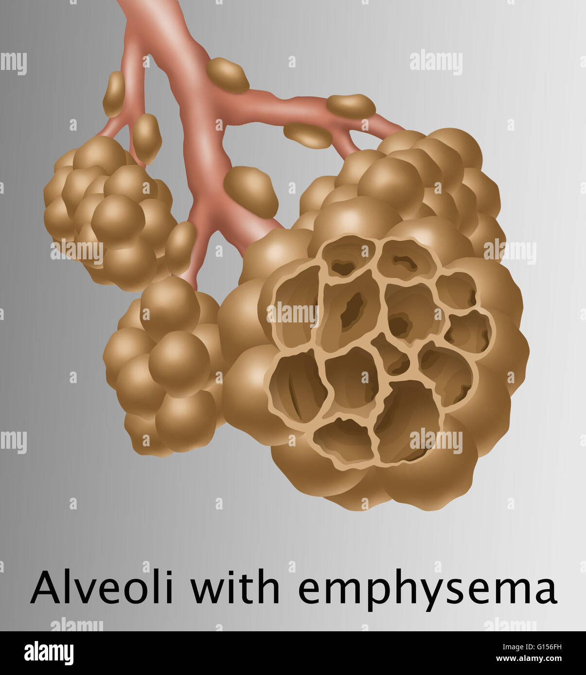 emphysema tobacco Emphysema: Common Causes, Symptoms, and Treatment Options Conceptual Illustration of Emphysema |