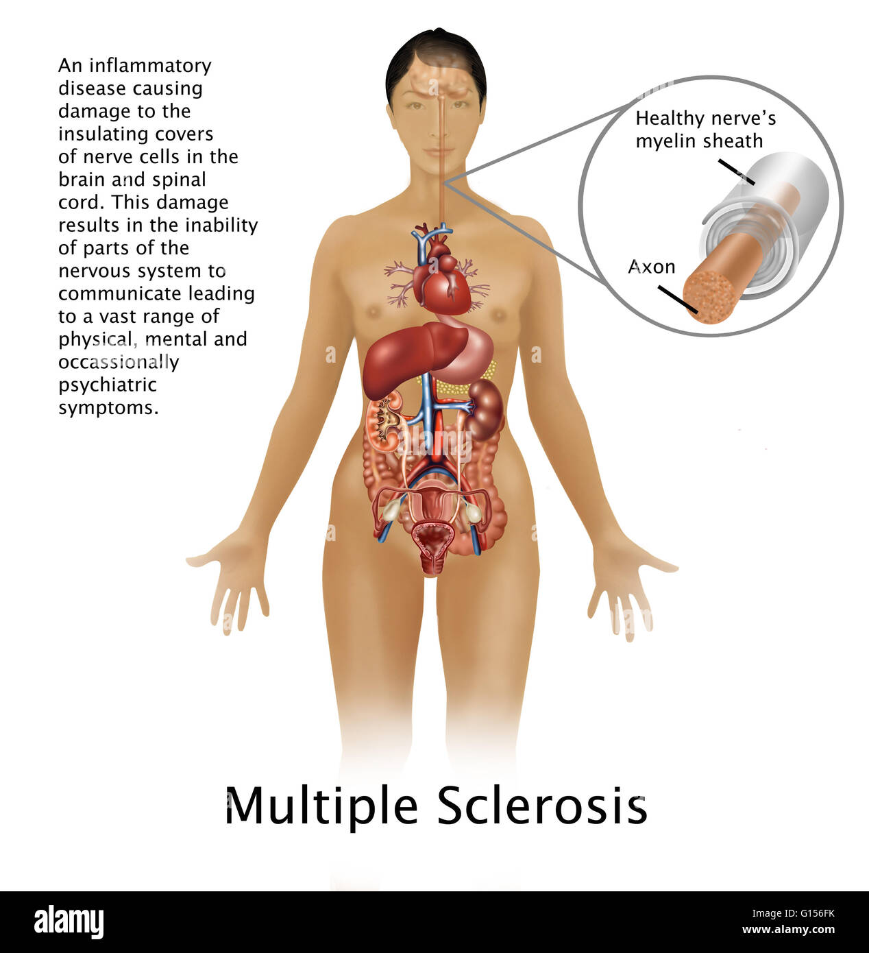 Illustration of a healthy nerve, with axon and myelin sheath, and its location in the body, along with information on multiple sclerosis, a disease which affects the nervous system. Stock Photo