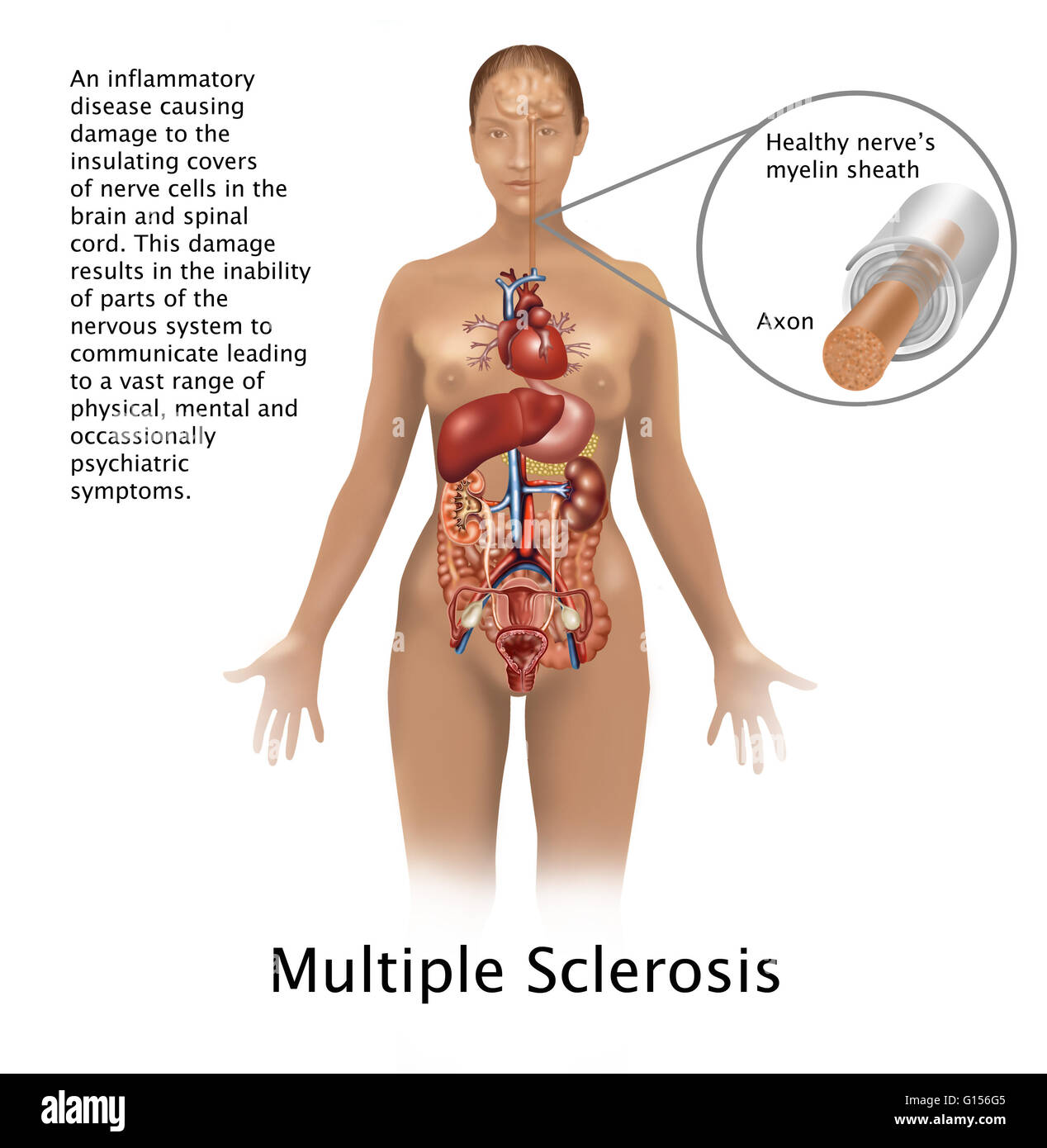 Illustration of a healthy nerve, with axon and myelin sheath, and its location in the body, along with information on multiple sclerosis, a disease which affects the nervous system. Stock Photo
