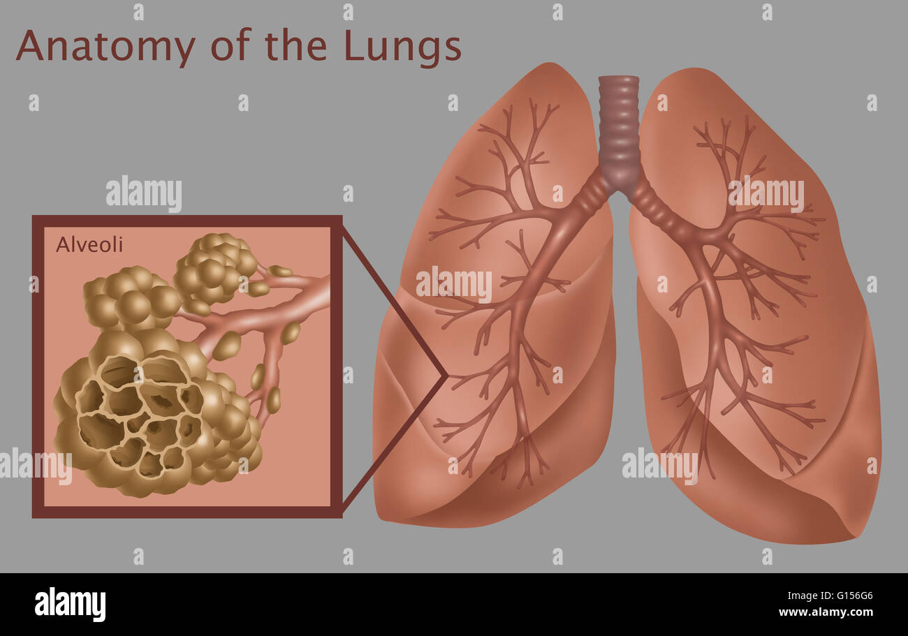 Illustration depicting lungs and alveoli damaged by emphysema. The