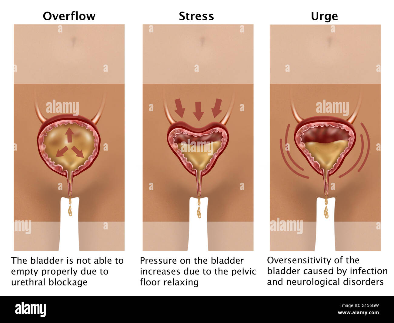 Illustration depicting three types of incontinence overflow