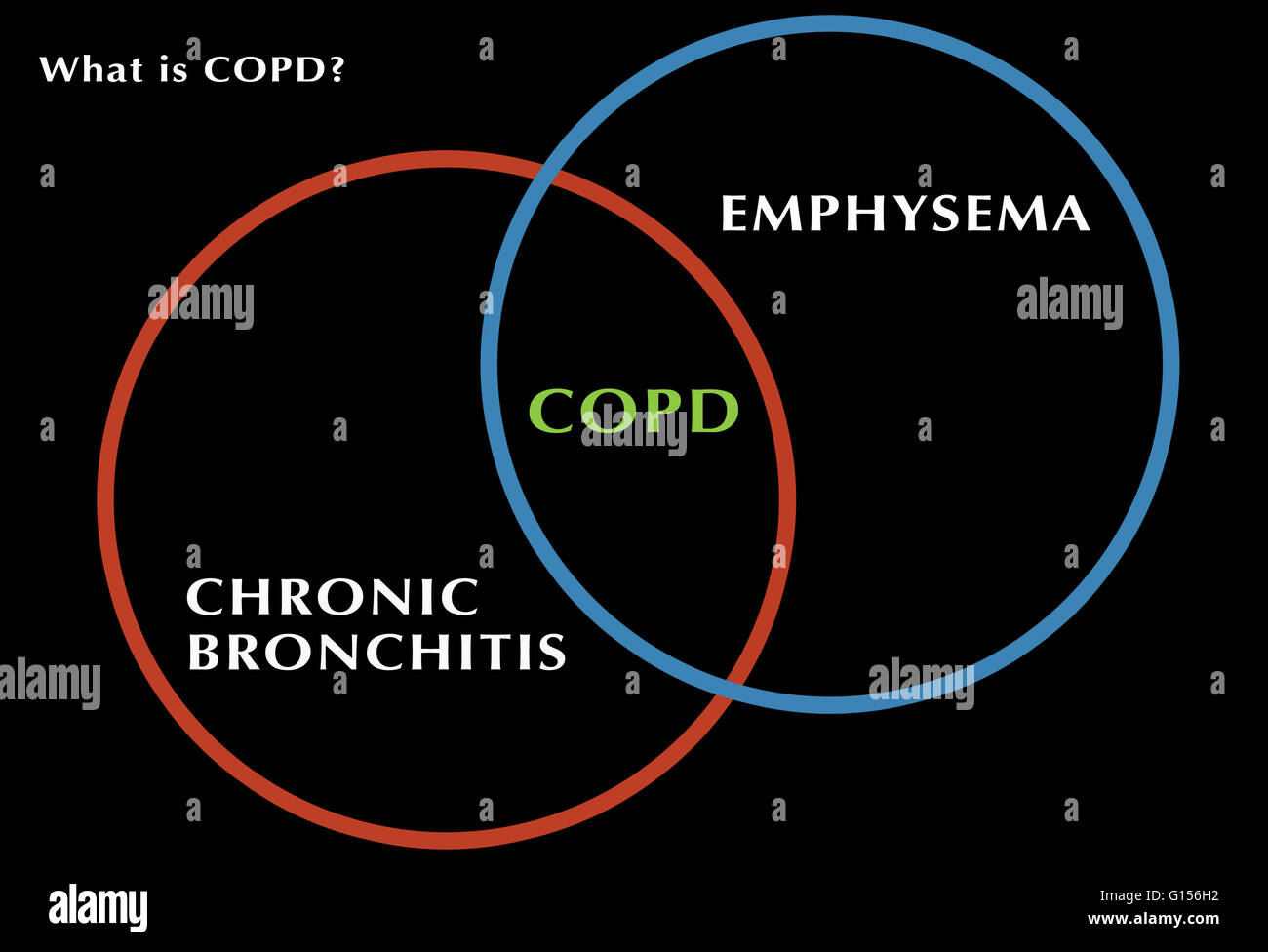 Diagram showing the relationship between chronic bronchitis, COPD ...