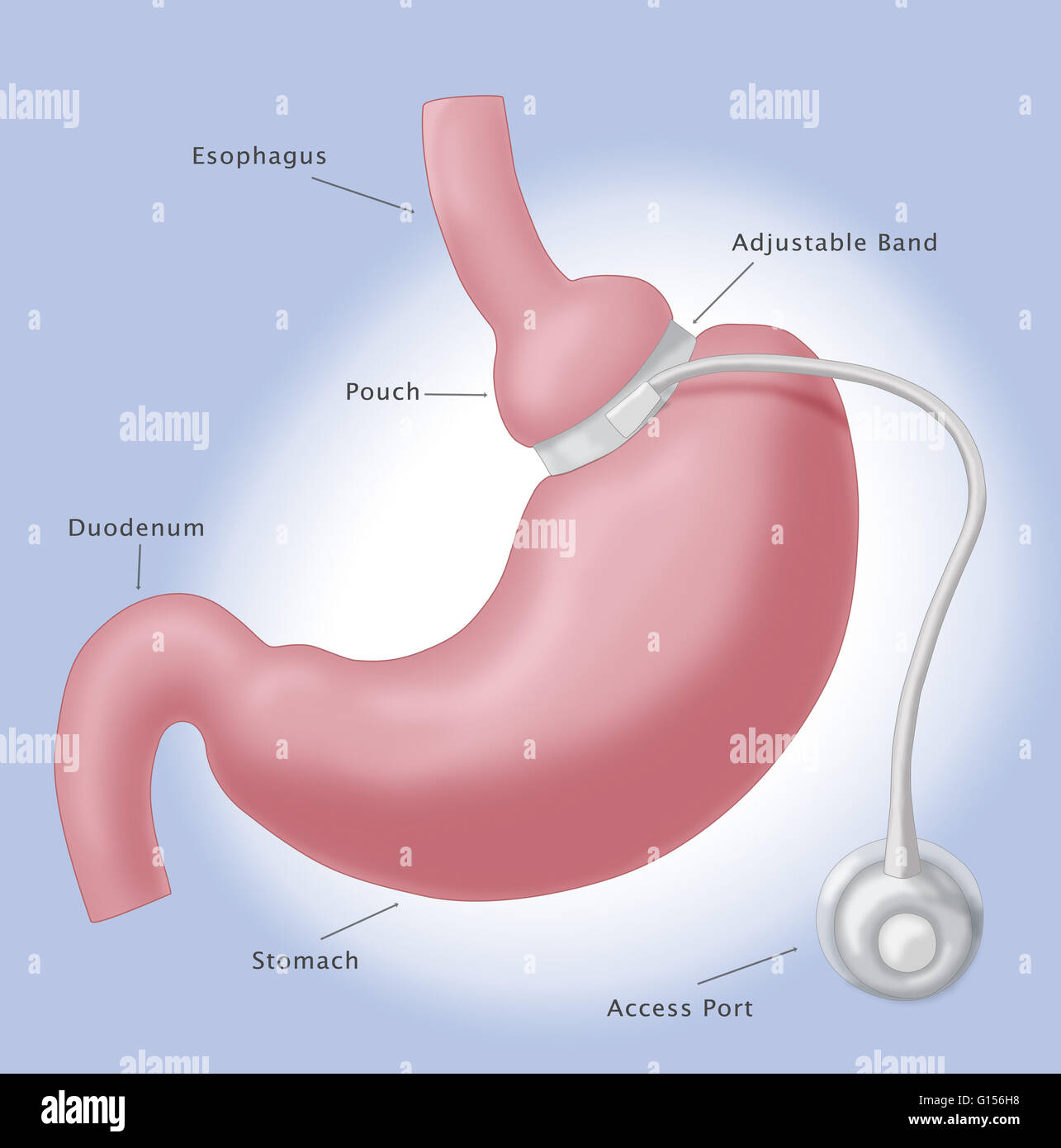 Gastric band operation hires stock photography and images Alamy