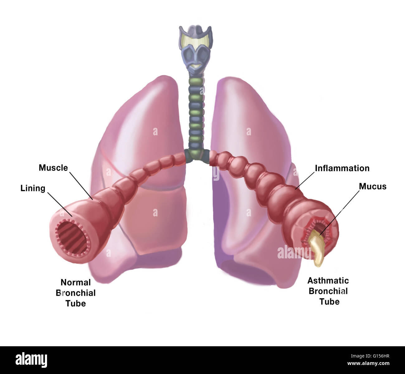 Illustration of the bronchial tubes of the lungs, comparing the