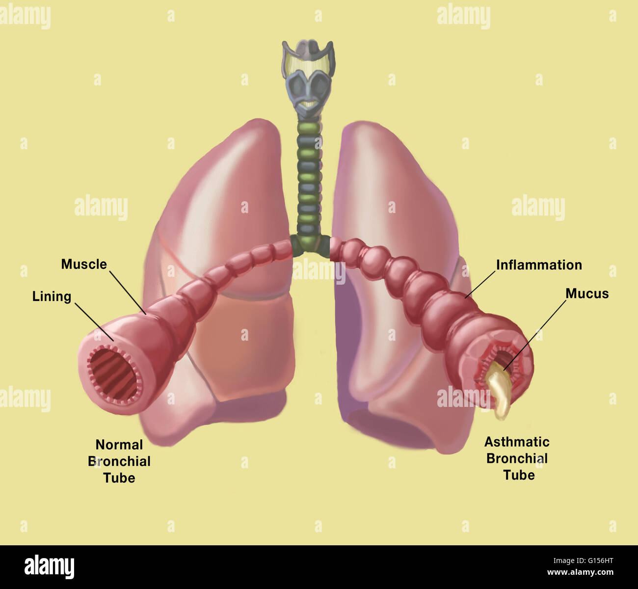 Illustration of the bronchial tubes of the lungs, comparing the appearance of a normal, healthy bronchial tube (left) to one in a person with asthma (right), in which case the bronchial tube becomes inflamed and clogged with mucus. Stock Photo