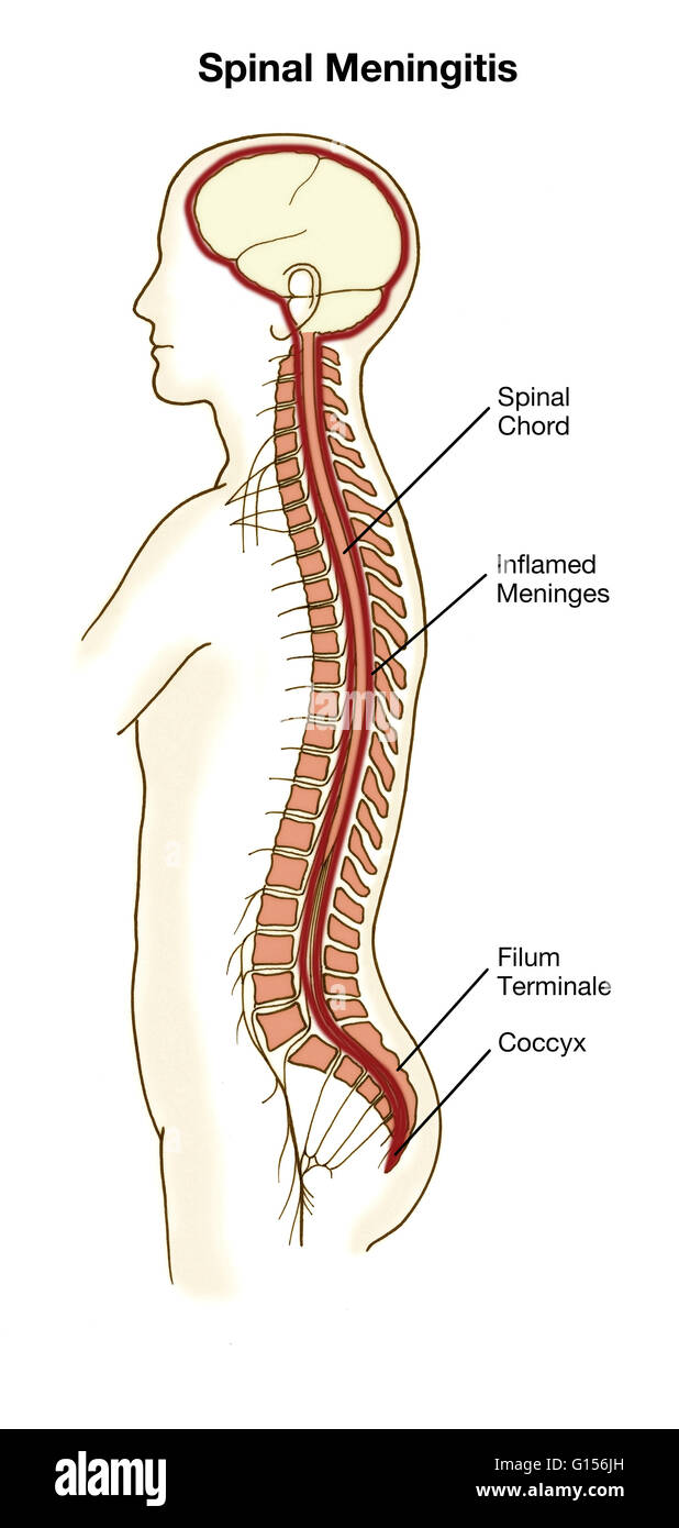 Diagram illustrating the symptoms of spinal meningitis. Meningitis is an  acute inflammation of the protective membranes covering the brain and spinal  cord, known collectively as the meninges. It may be caused by