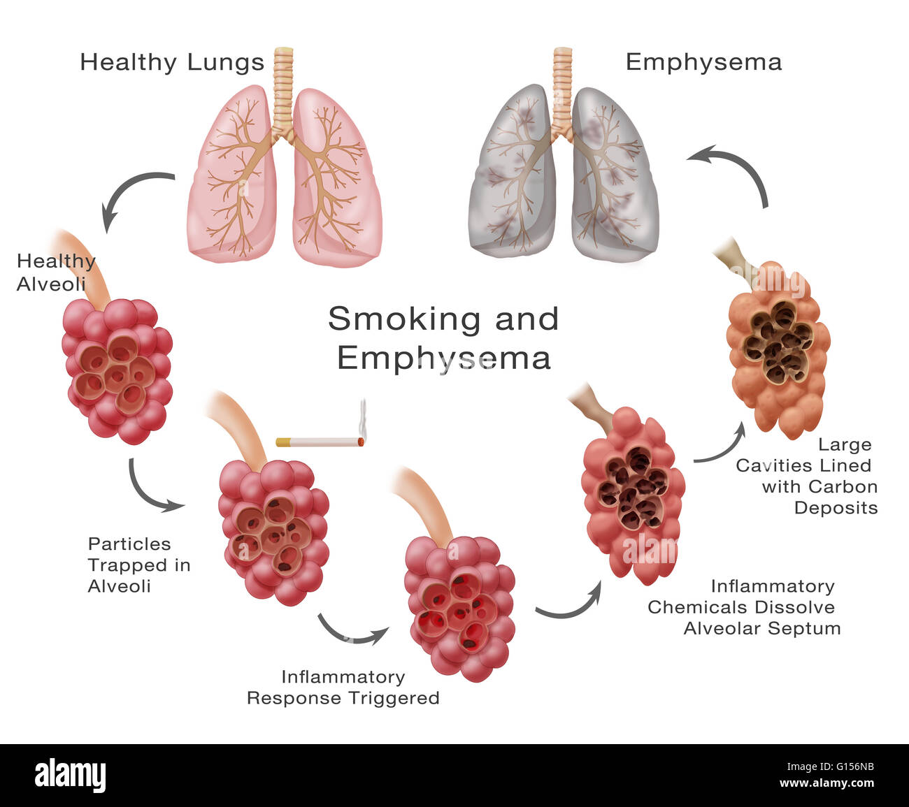 How Does Emphysema Affect Your Lungs - PELAJARAN