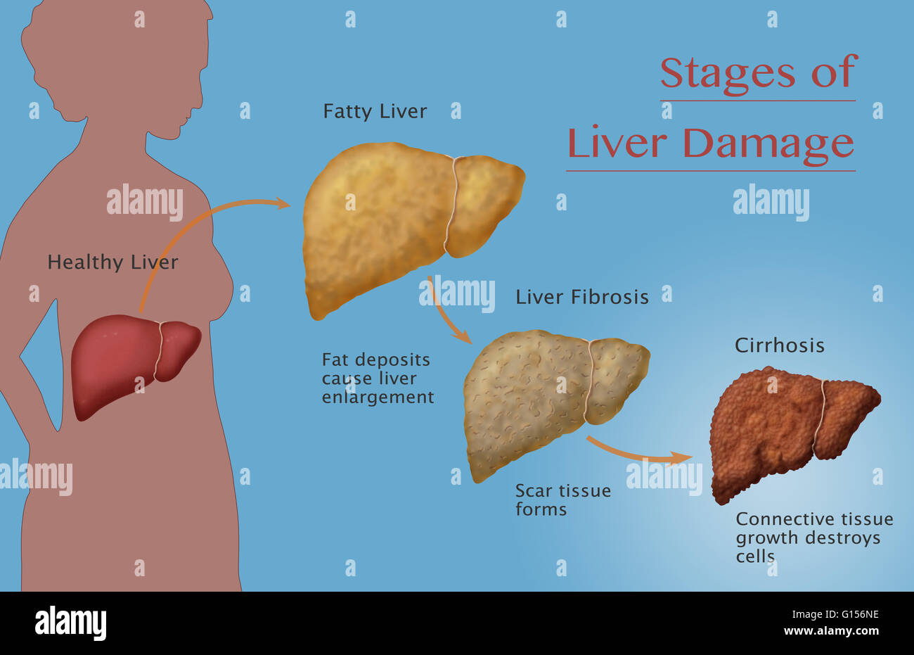 Stages Of Liver Disease