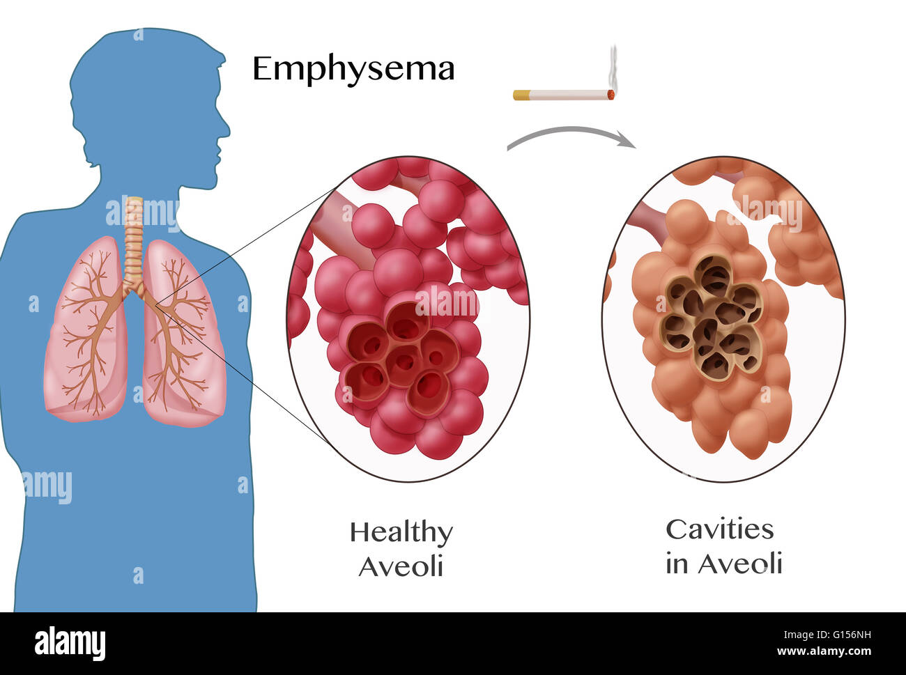 Emphysema Histology