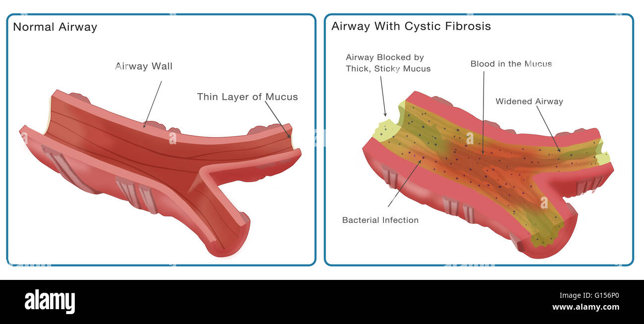 Illustration comparing a normal bronchiole (at left) to a blocked bronchial resulting in cystic fibrosis (at right). The bronchial at right is blocked by a thick, sticky and bloody mucus, has a bacterial infection (small black dots), and a widened airway. Stock Photo