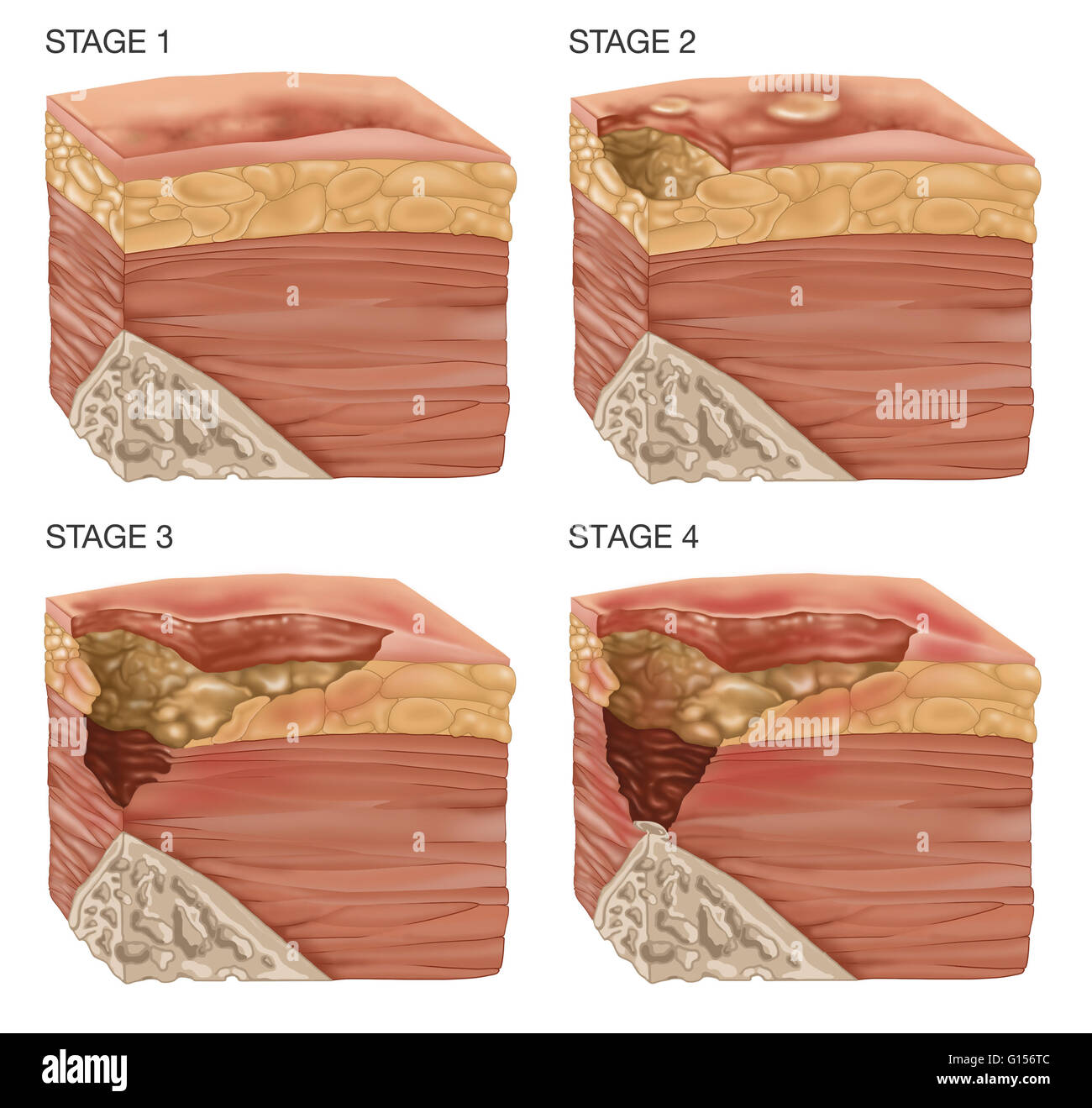 Illustration of the 4 stages of a bedsore. Bedsores or pressure sores can be caused by many factors including unrelieved pressure, friction, humidity, etc. Bedsores usually afflict the frail and elderly, wheelchair bound people and the terminally ill. Bed Stock Photo