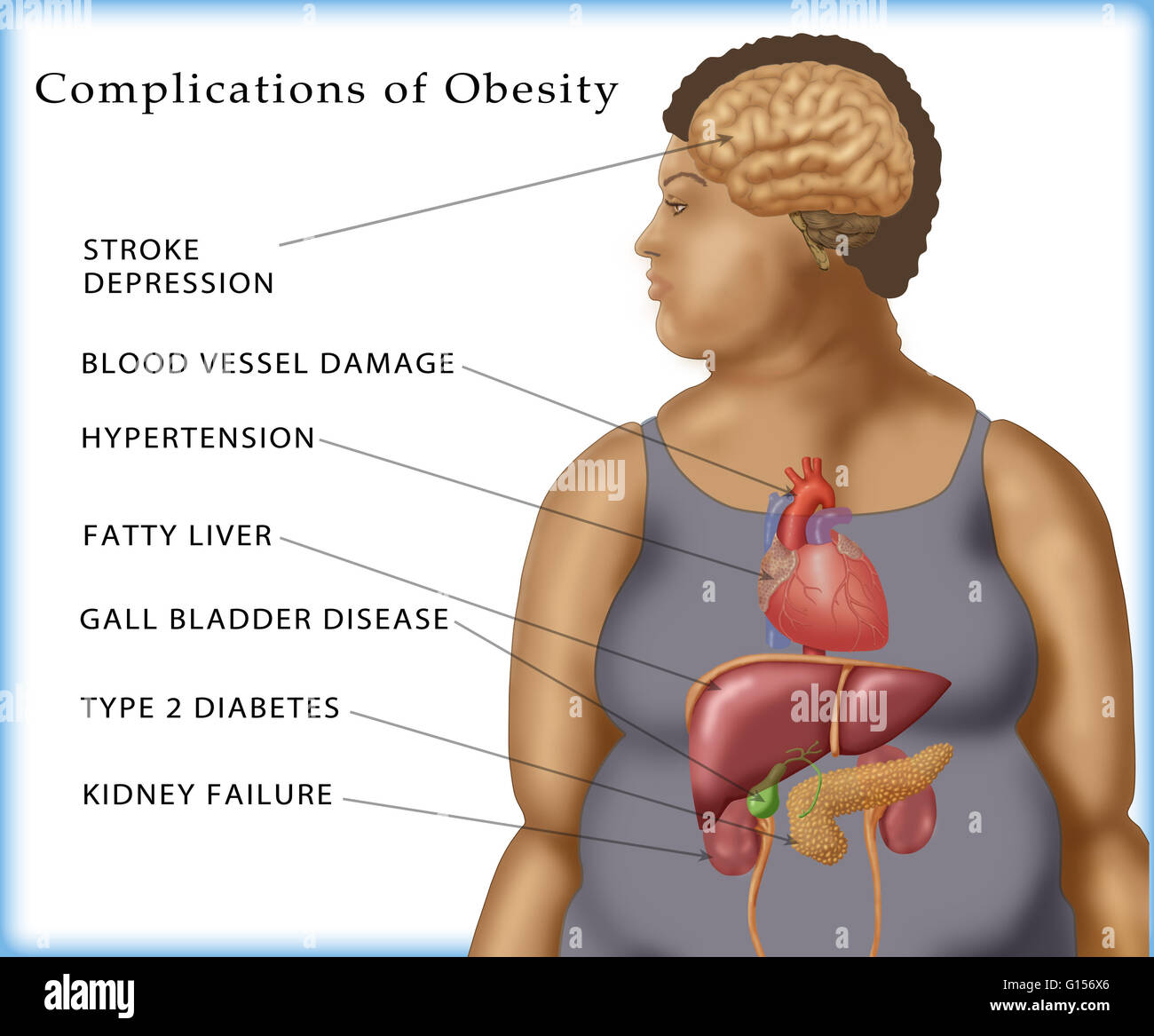 Obesity Meaning In Medical Terminology