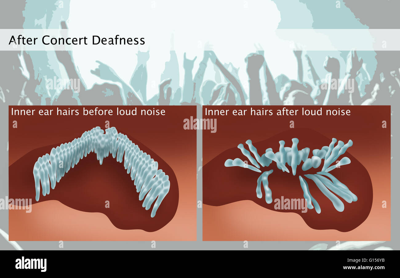 Loud music, such as at a live music concert can cause damage to ears and hearing. Illustrated here are the hairs of the inner ear before (at left), and after (at right) loud noise. Damage to these hair cells will result in decreased hearing sensitivity, a Stock Photo