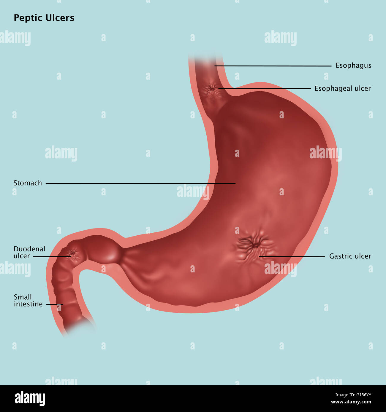 Gastric ulcer present hires stock photography and images Alamy