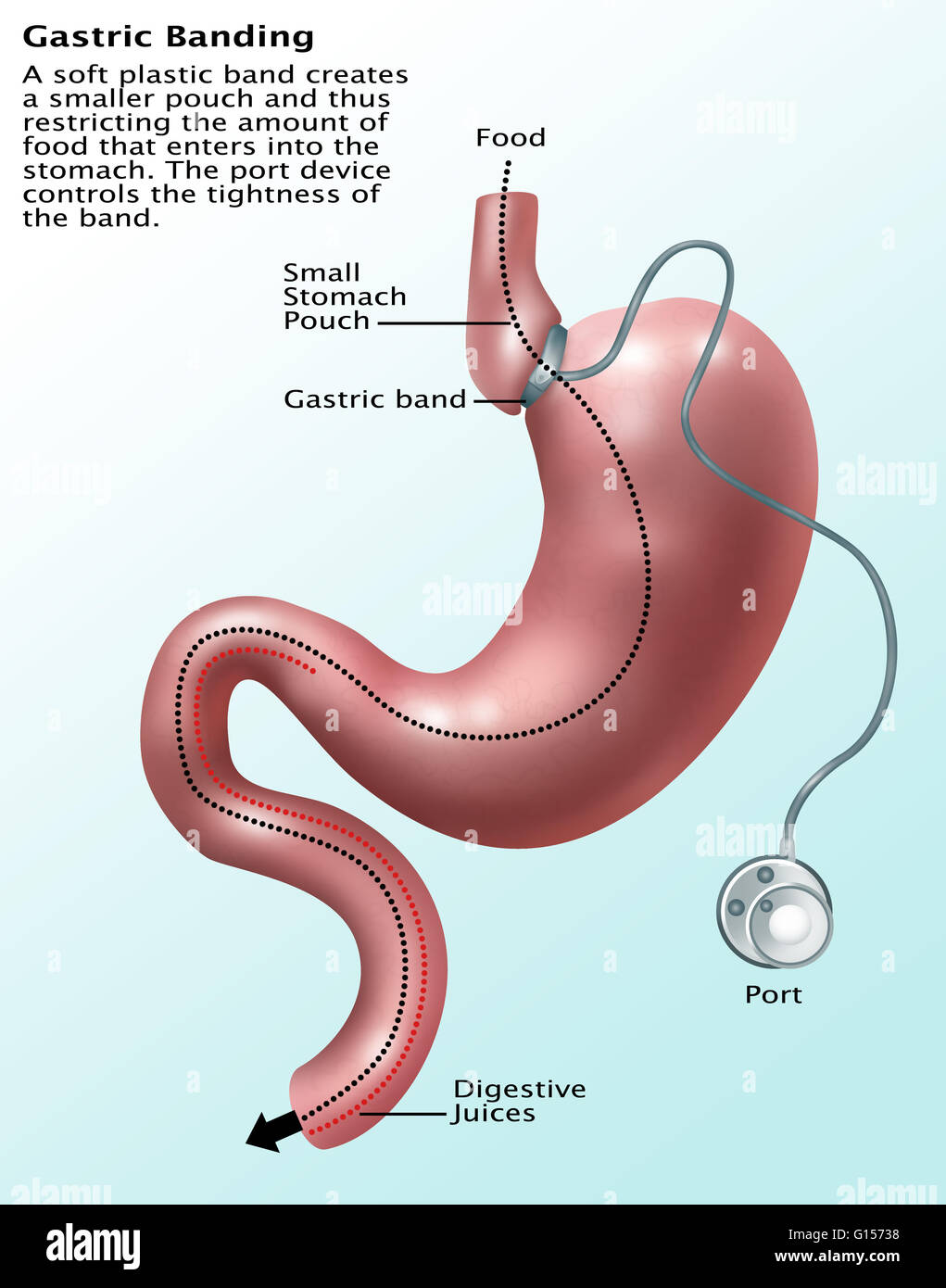 Gastric band hires stock photography and images Alamy