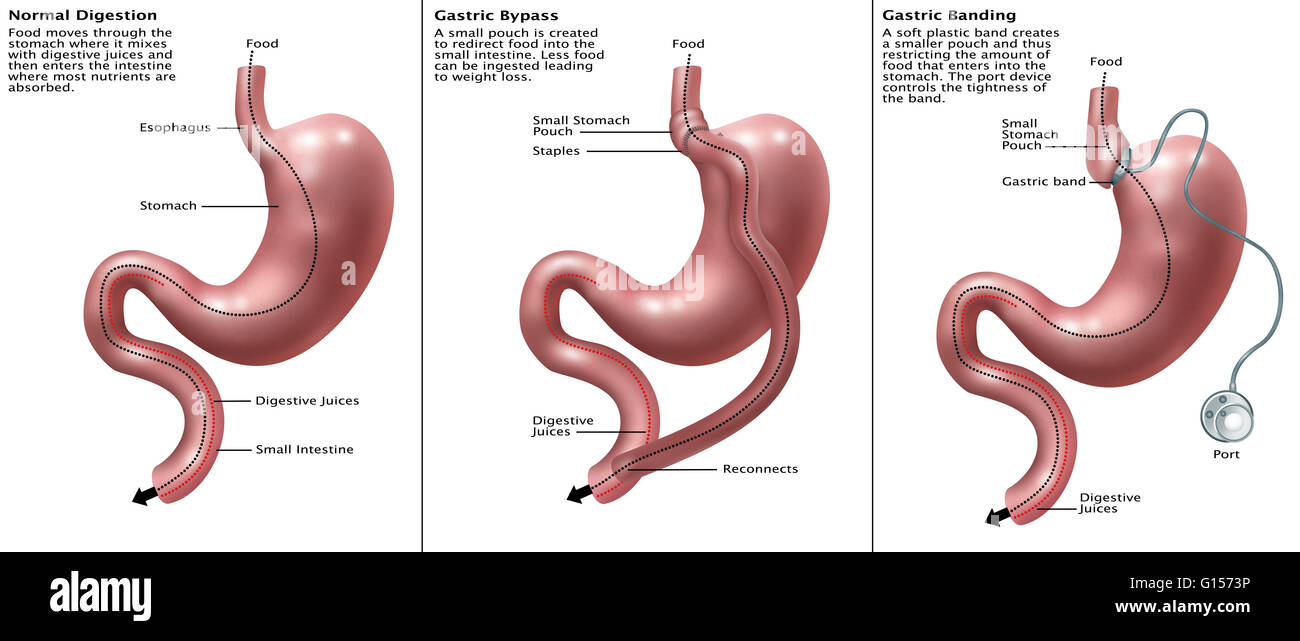 Illustration of three human digestive systems. Far left shows a normal