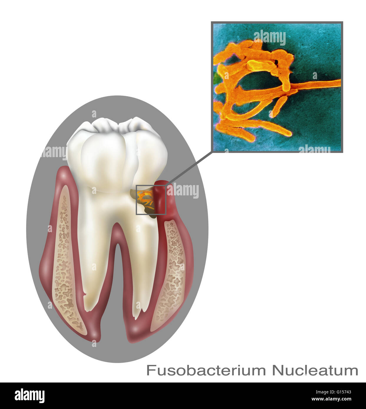 Fusobacterium nucleatum, oral bacteria found in the dental plaque of humans. Associated with the periodontal gum disease. Stock Photo