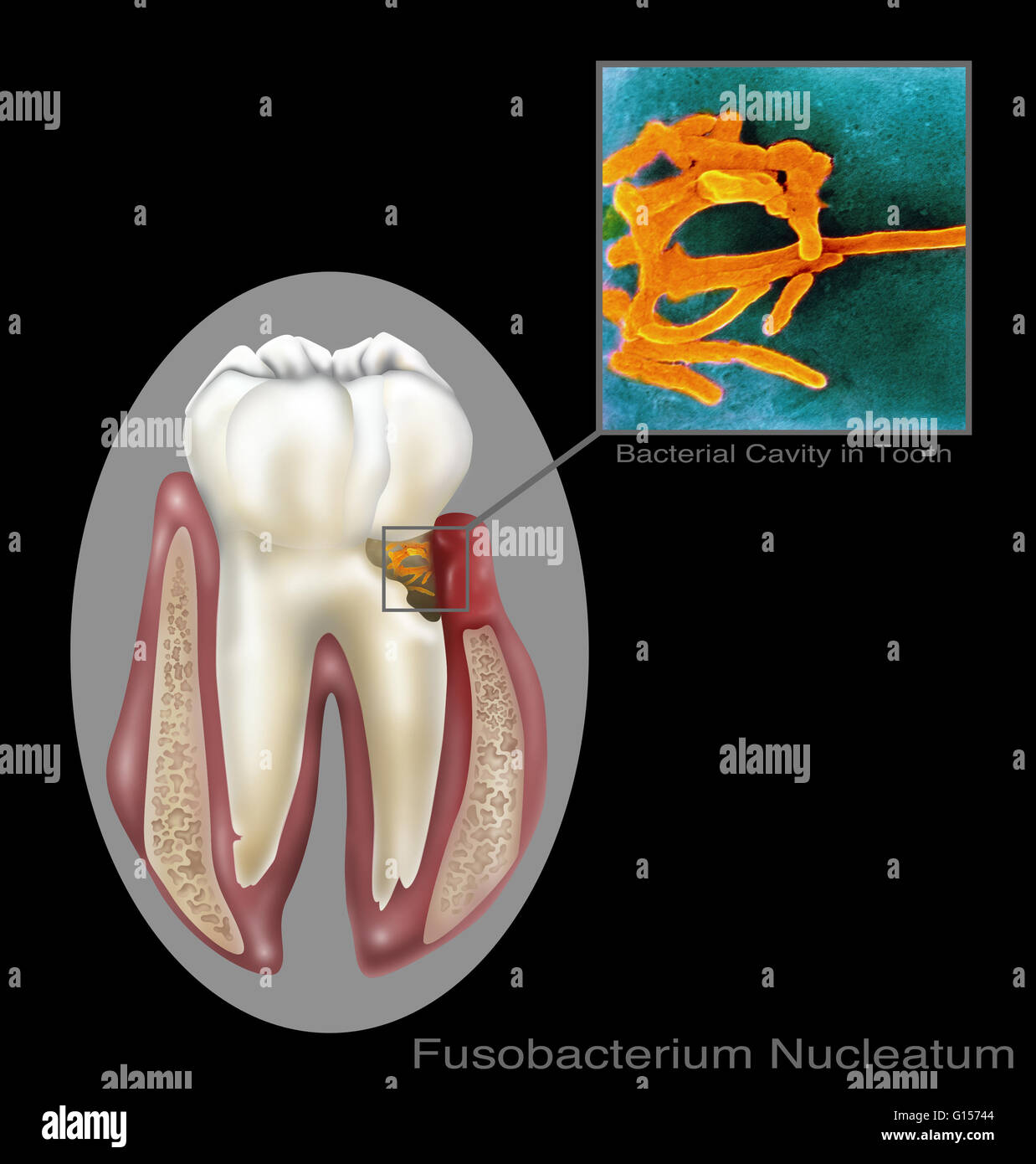 Fusobacterium nucleatum, oral bacteria found in the dental plaque of humans. Associated with the periodontal gum disease. Stock Photo