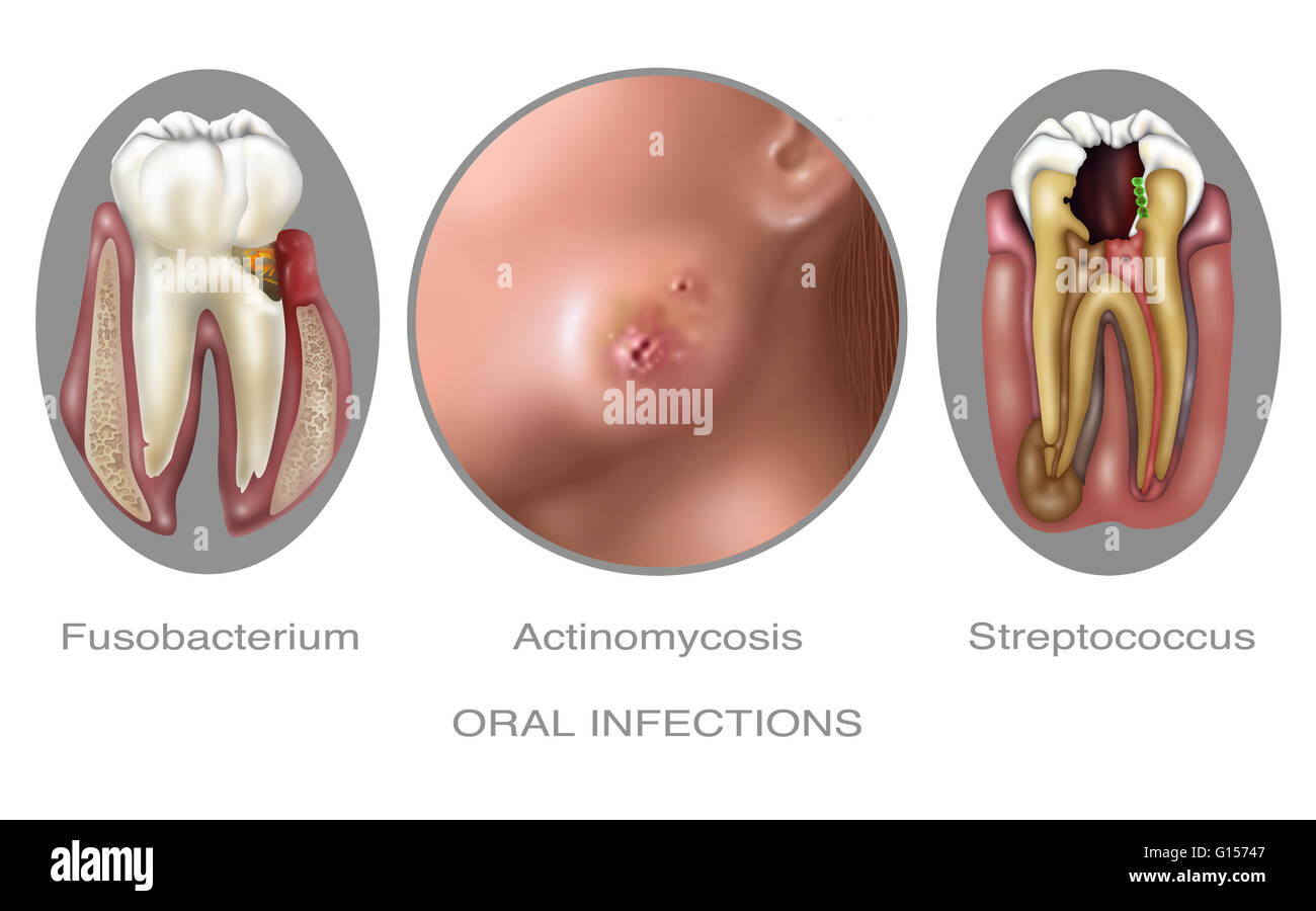 Illustration of oral Infections caused by bacteria. Fusobacterium nucleatum, is an oral bacteria found in the dental plaque of humans. Associated with the periodontal gum disease. Actinomycosis. This Bacterial infection begins in the spaces between the te Stock Photo
