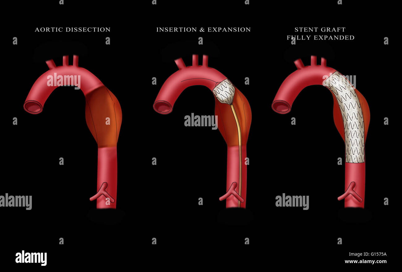 Illustration depicting insertion of an aortic aneurysm stent. Far left ...