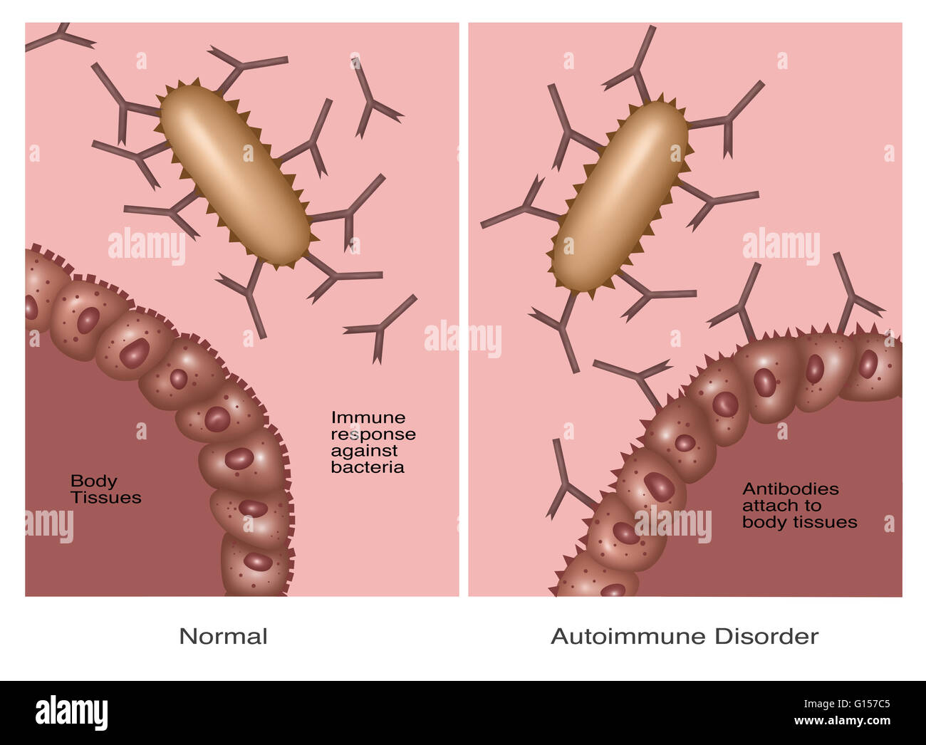 Illustration comparing a normal immune system (left) to the affects of ...