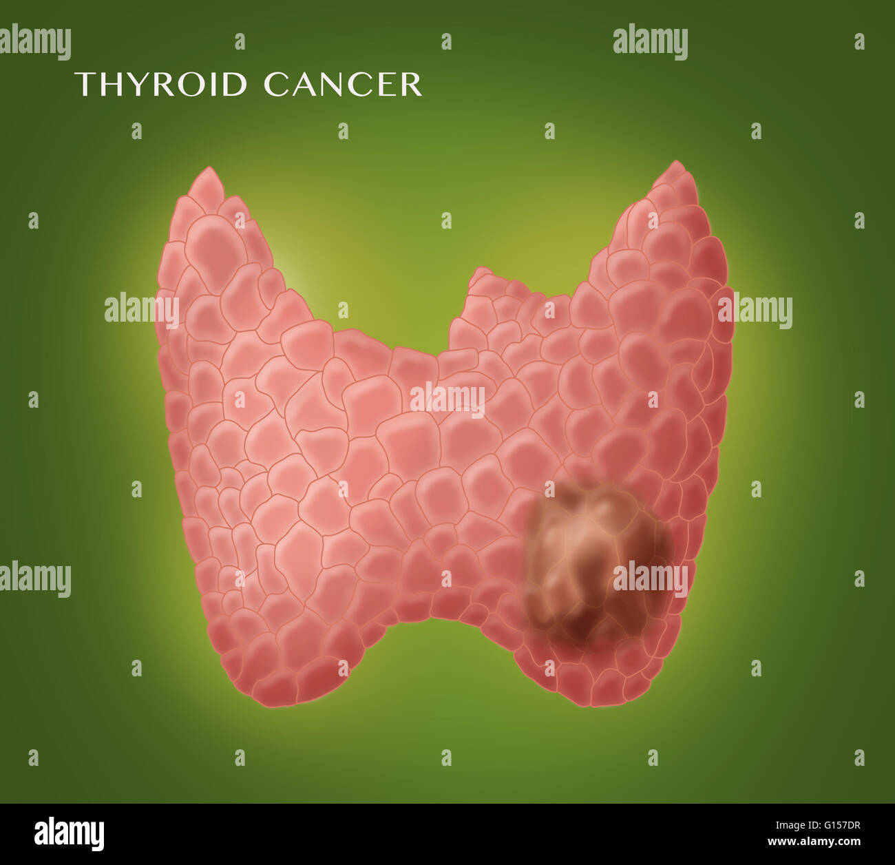 Illustration showing thyroid cancer. Stock Photo