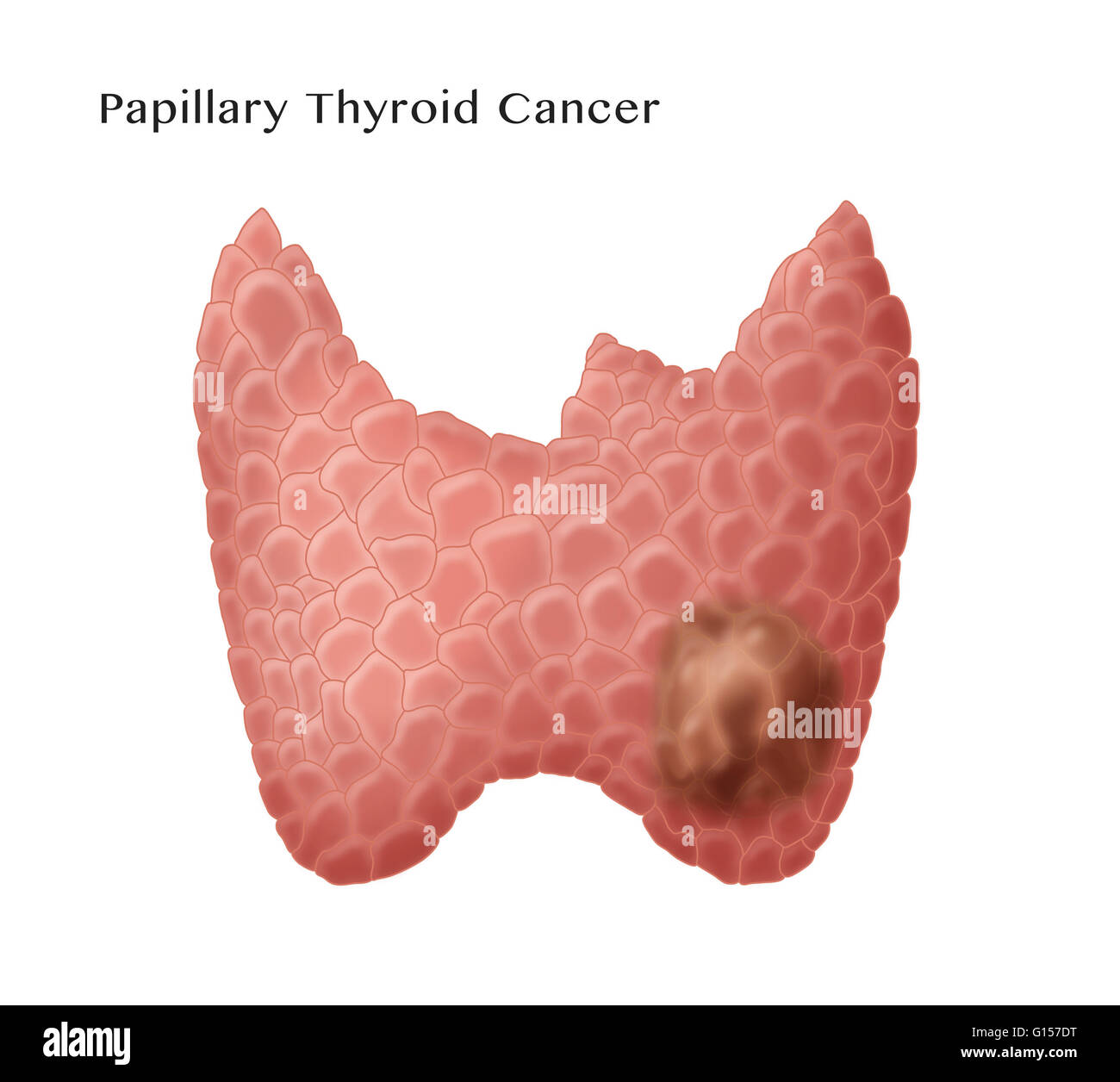 Labeled illustration showing papillary thyroid cancer, the most common form of thyroid cancer. Stock Photo