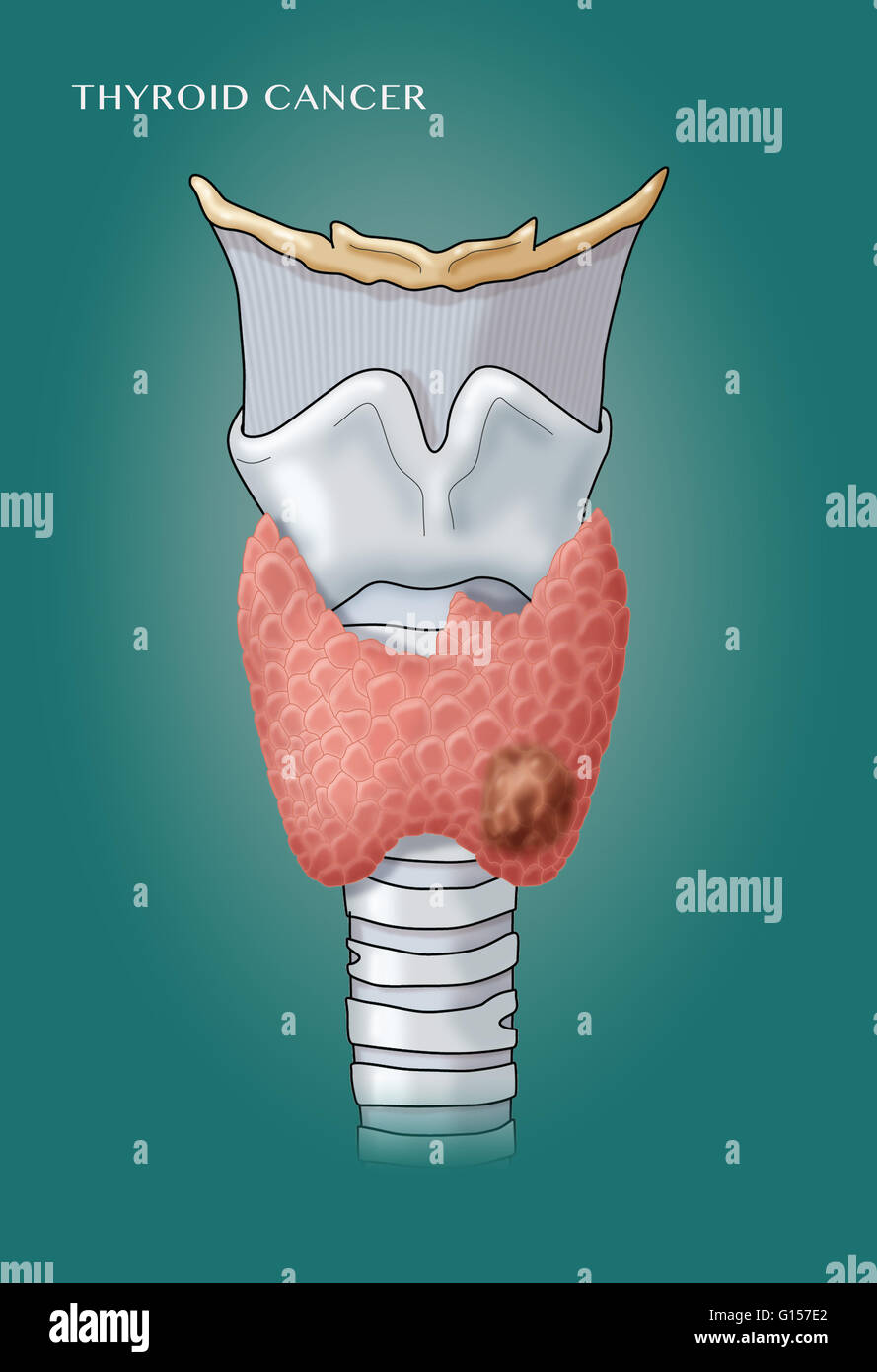 Labeled illustration of the larynx and thyroid gland, showing a malignant growth (thyroid cancer). Stock Photo