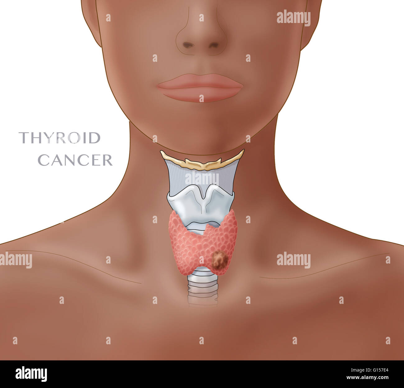 Thyroid cancer. Labeled illustration showing the location of the larynx and thyroid gland in a female figure. A malignant growth can be seen in the lower right area of the thyroid. Stock Photo