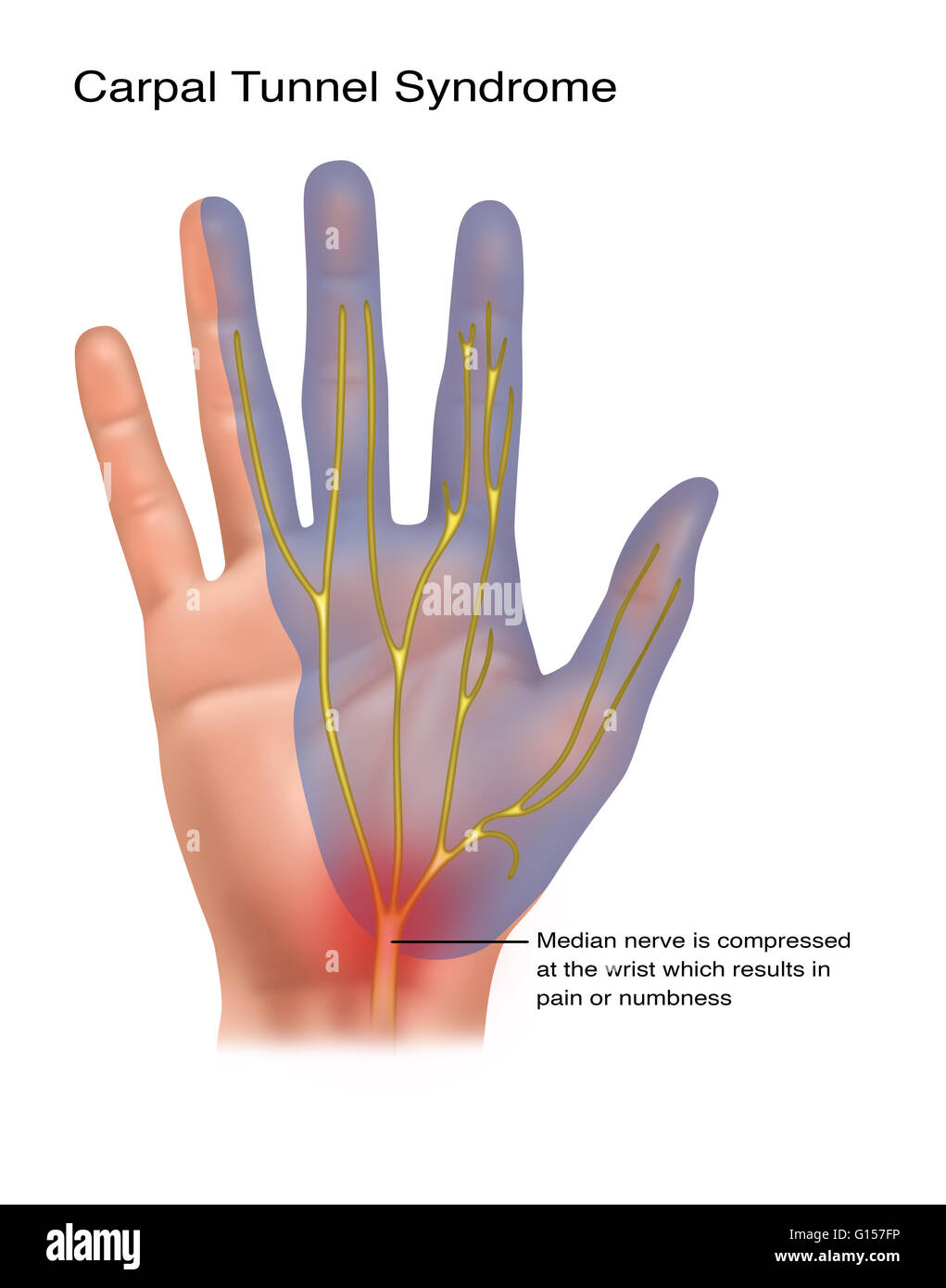 Illustration Depicting Carpal Tunnel Syndrome Carpal Tunnel Happens When The Median Nerve Is