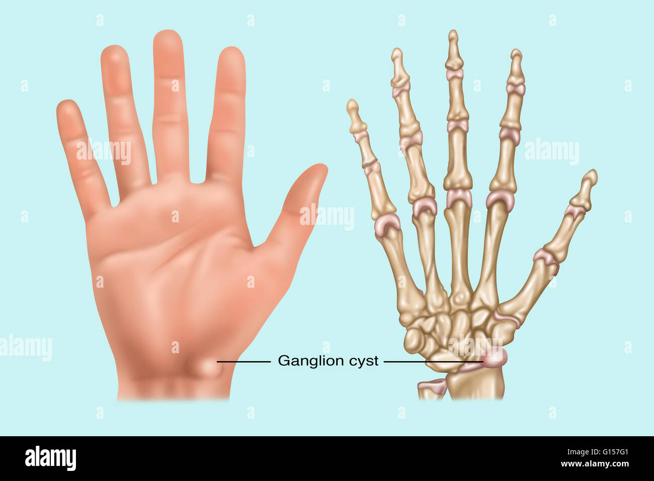 Illustration showing a ganglion cyst (fluid filled sac) in the wrist. Shown both on the skin surface and on the bone. Stock Photo