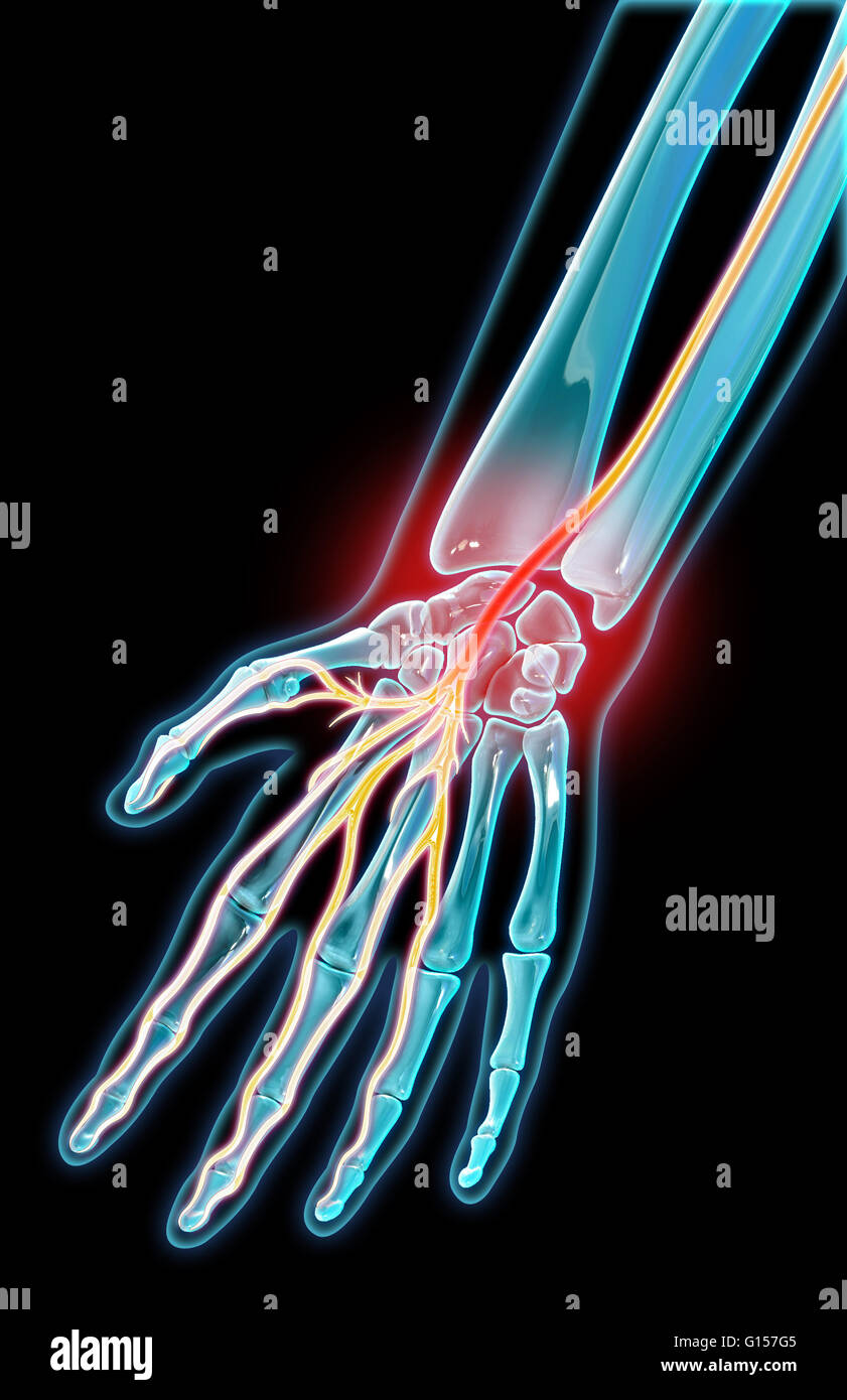 A 3D model of the wrist and median nerve during carpal tunnel syndrome