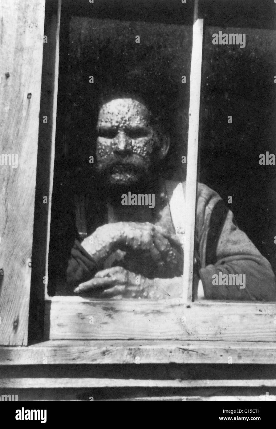 Man with Smallpox in isolation, 1890. Smallpox is an acute, infectious viral disease transmitted by direct contact with infected people. Fever symptoms commence 8-18 days after exposure. After 3 days, red spots appear on the face and body and develop into Stock Photo