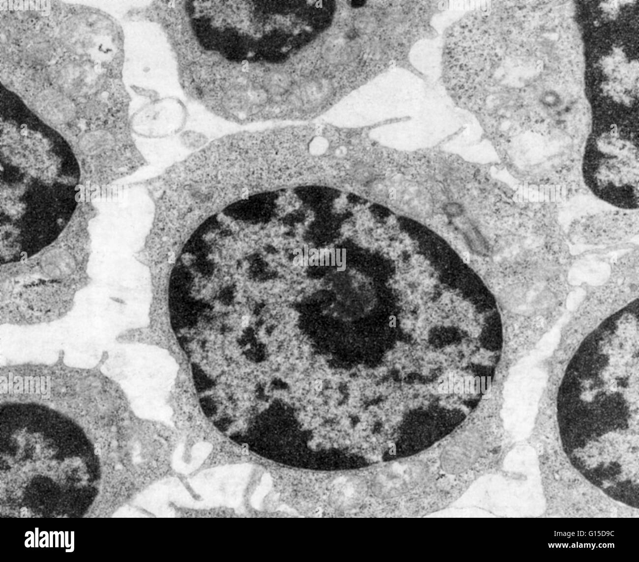 Transmission electron microscopy (TEM) of white blood cells in a patient  with leukemia. The white blood cells of in someone with leukemia multiply  quickly as the bone marrow and other tissues in