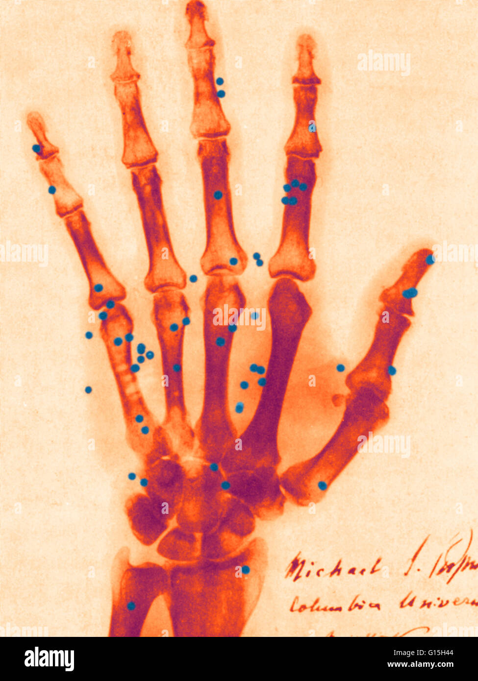 Color enhanced x-ray of gunshot in the hand. In February of 1896, Professor Michael Pupin of Columbia University radiographed the hand of a New York attorney accidentally shot. This image, signed by Pupin, is one of the earliest records of the practical u Stock Photo