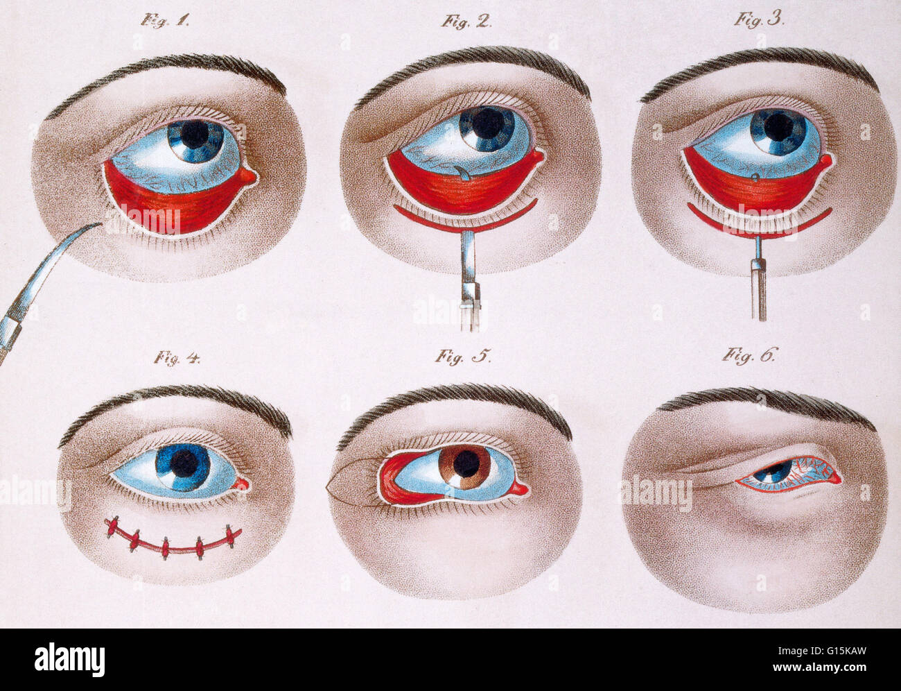 Illustration showing the surgical procedure to correct a lazy lower eyelid (ptosis), c. 1830. Ptosis is a drooping or falling of the upper or lower eyelid. The drooping may be worse after being awake longer, when the individual's muscles are tired. This c Stock Photo