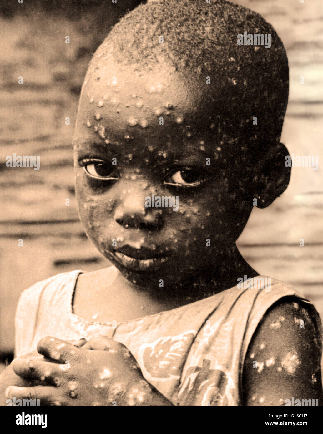 A Congolese child with smallpox, from 1965. Smallpox has now been Stock