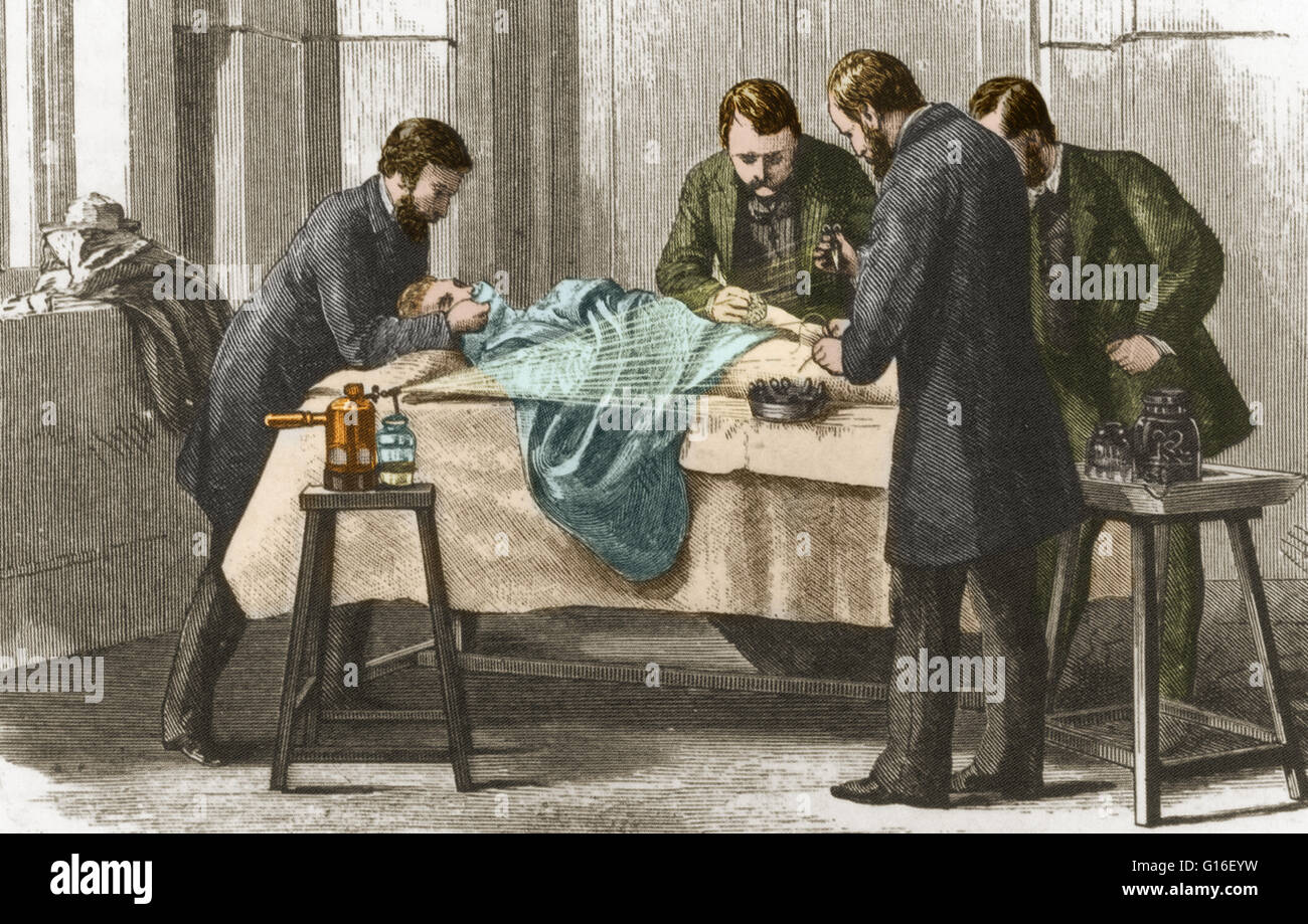 Lister's antiseptic spray in action during surgery. Sir Joseph Lister