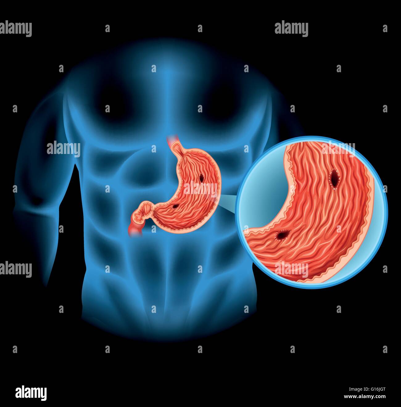 Stomach Ulcer diagram in human illustration Stock Vector
