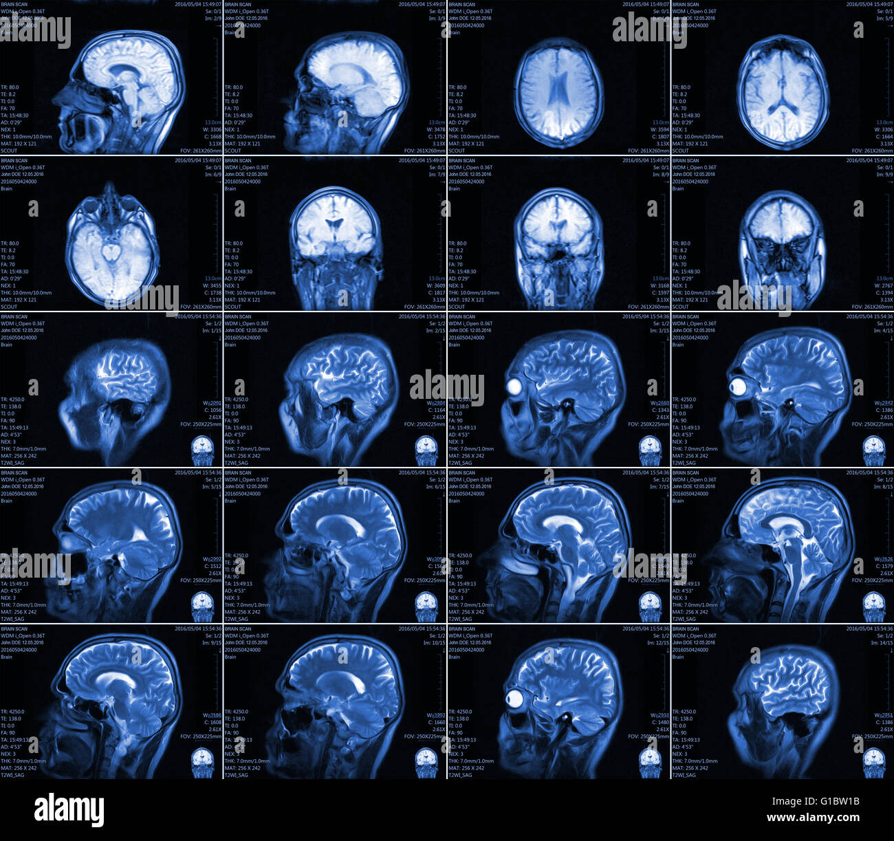 Magnetic Resonance Imaging Of The Brain Stock Photo Alamy