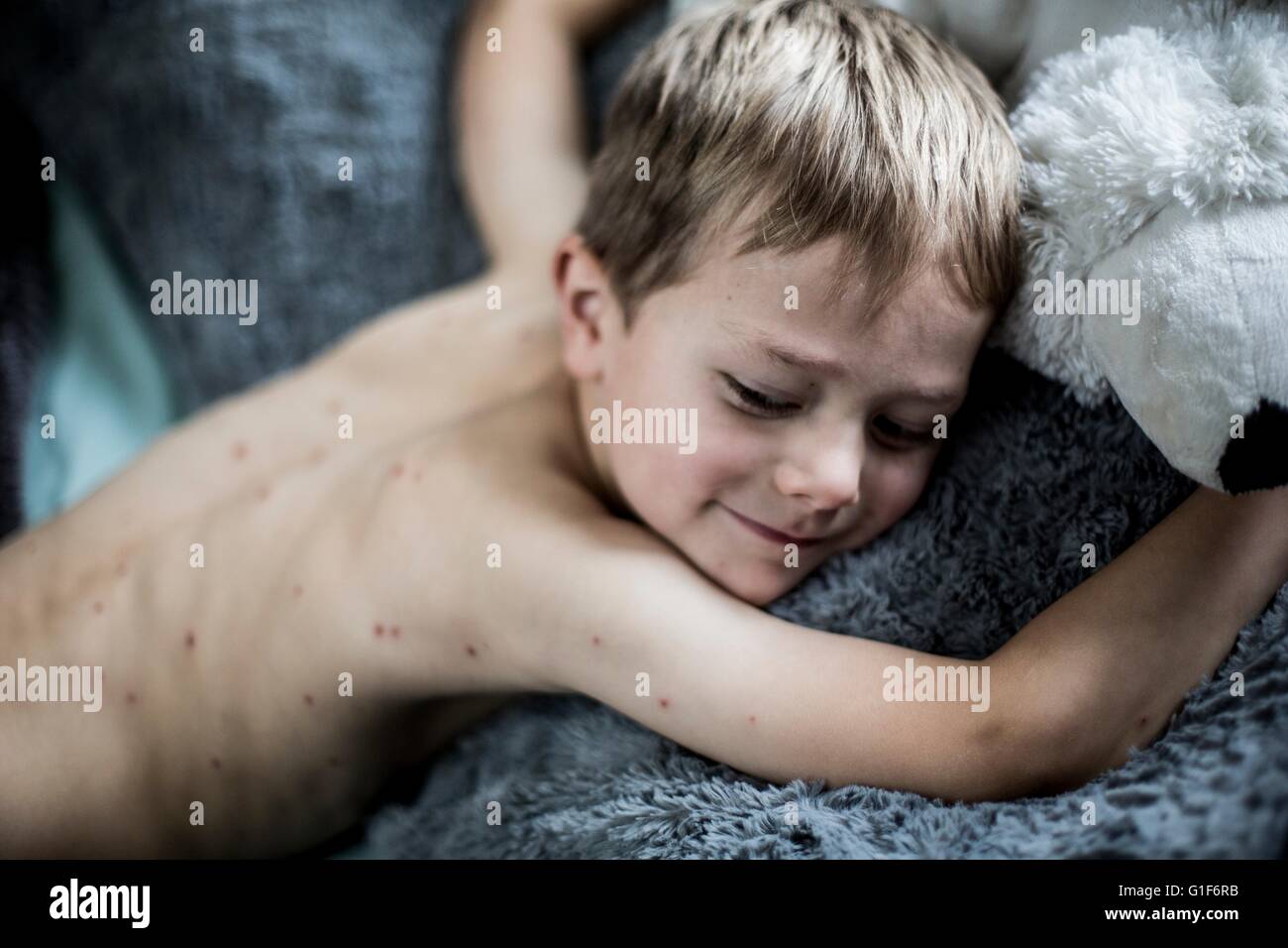 Model Released. Young Boy Lying Down With Chickenpox Stock Photo - Alamy